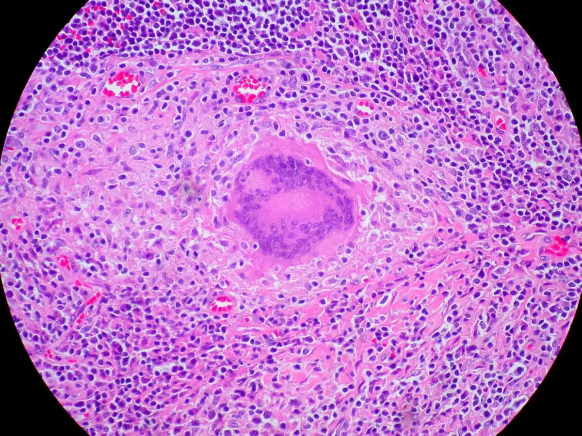 Micrografia di un granuloma non caseoso: al centro una grande cellula gigante multinucleata con i nuclei disposti a ferro di cavallo lungo il bordo, circondata da cellule epitelioidi e da molti linfociti