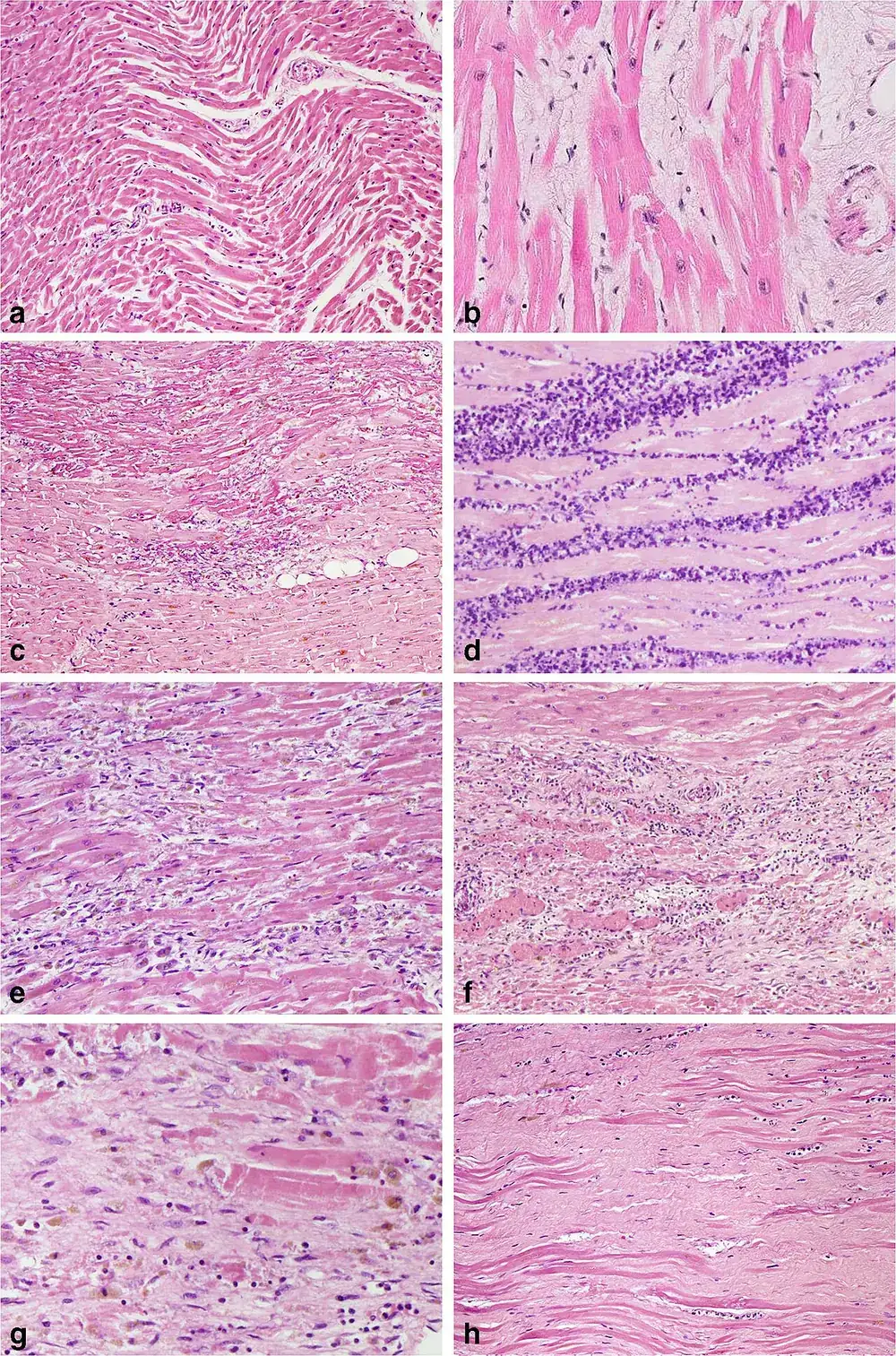 Otto micrografie in ematossilina-eosina del miocardio dopo un infarto, dalla fase iniziale alla cicatrice: fibre ondulate, edema, necrosi coagulativa, infiltrato di granulociti, macrofagi e linfociti, tessuto di granulazione, fibroblasti e collagene, cicatrice fibrosa densa